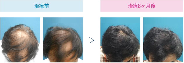 52歳 治療8ヶ月後のビフォーアフター